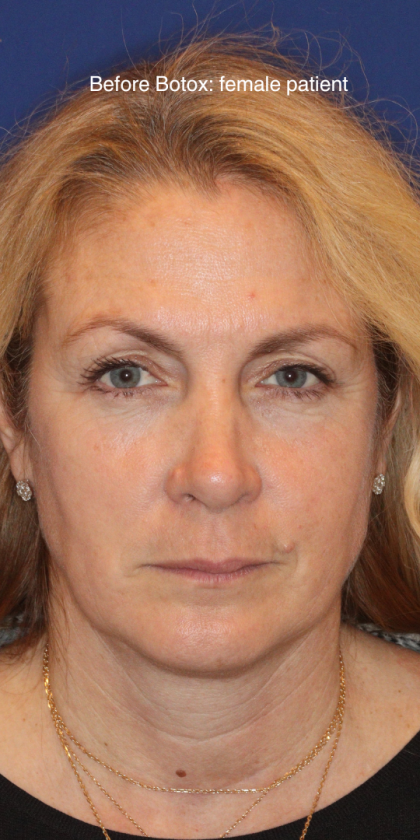 Botox & Wrinkle Relaxers Before & After Patient #15141
