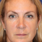 Botox & Wrinkle Relaxers Before & After Patient #15141
