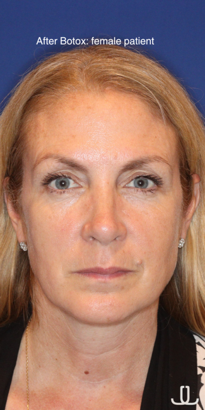 Botox & Wrinkle Relaxers Before & After Patient #15141