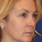 Botox & Wrinkle Relaxers Before & After Patient #15141