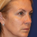 Botox & Wrinkle Relaxers Before & After Patient #15141