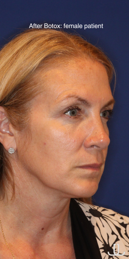 Botox & Wrinkle Relaxers Before & After Patient #15141