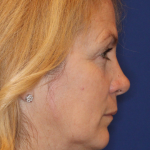 Botox & Wrinkle Relaxers Before & After Patient #15141