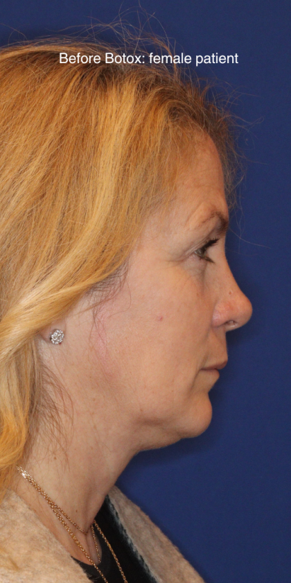 Botox & Wrinkle Relaxers Before & After Patient #15141