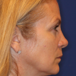 Botox & Wrinkle Relaxers Before & After Patient #15141
