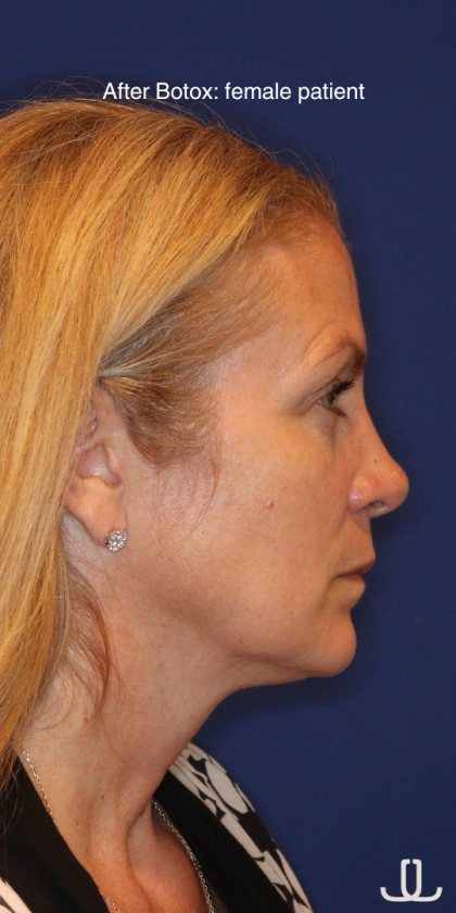 Botox & Wrinkle Relaxers Before & After Patient #15141