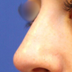 Non-Surgical Nose Job Before & After Patient #15147
