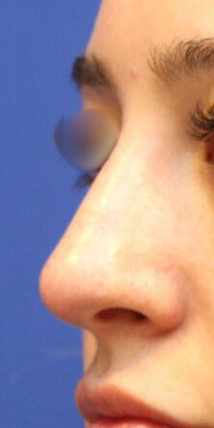 Non-Surgical Nose Job Before & After Patient #15147