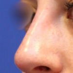 Non-Surgical Nose Job Before & After Patient #15147