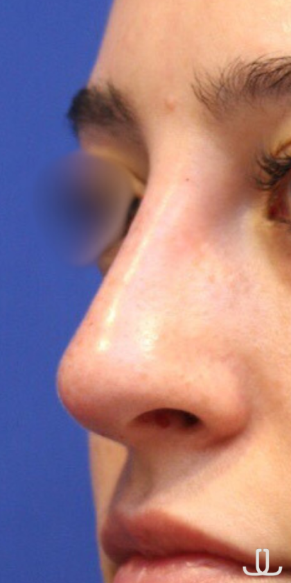 Non-Surgical Nose Job Before & After Patient #15147
