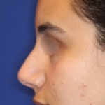 Non-Surgical Nose Job Before & After Patient #15148