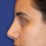 Non-Surgical Nose Job Before & After Patient #15148