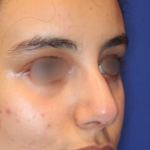 Non-Surgical Nose Job Before & After Patient #15148