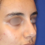 Non-Surgical Nose Job Before & After Patient #15148