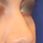 Non-Surgical Nose Job Before & After Patient #15149