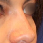 Non-Surgical Nose Job Before & After Patient #15149