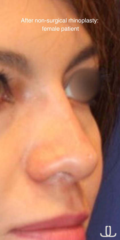 Non-Surgical Nose Job Before & After Patient #15149