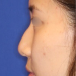Non-Surgical Nose Job Before & After Patient #13879