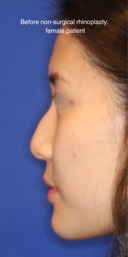 Non-Surgical Nose Job Before & After Patient #13879