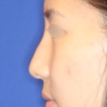 Non-Surgical Nose Job Before & After Patient #13879