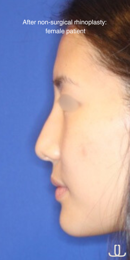 Non-Surgical Nose Job Before & After Patient #13879