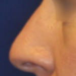 Non-Surgical Nose Job Before & After Patient #15151