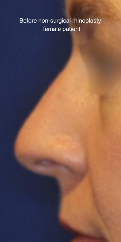 Non-Surgical Nose Job Before & After Patient #15151