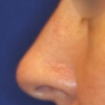 Non-Surgical Nose Job Before & After Patient #15151