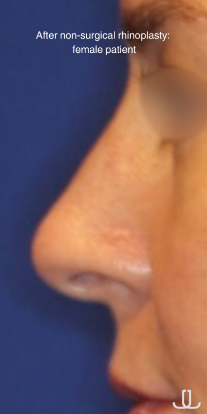 Non-Surgical Nose Job Before & After Patient #15151