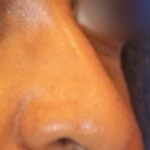 Non-Surgical Nose Job Before & After Patient #13876