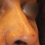 Non-Surgical Nose Job Before & After Patient #13876