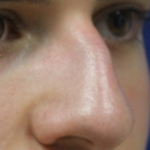 Rhinoplasty Before & After Patient #13749