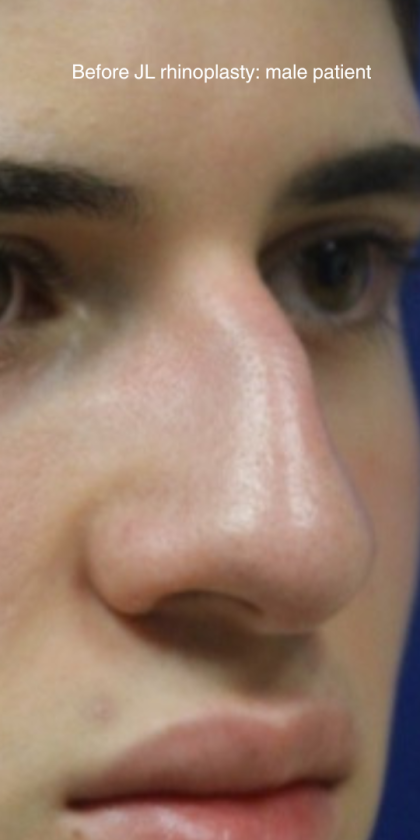 Rhinoplasty Before & After Patient #13749