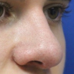 Rhinoplasty Before & After Patient #13749