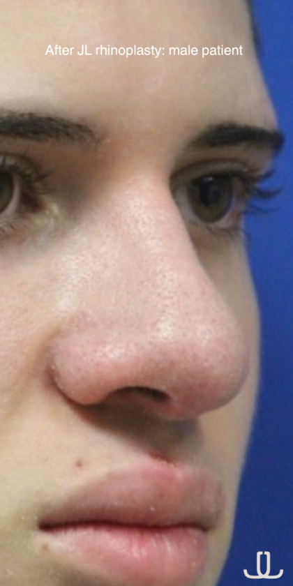 Rhinoplasty Before & After Patient #13749