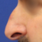 Rhinoplasty Before & After Patient #13785