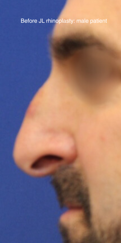 Rhinoplasty Before & After Patient #13785