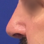Rhinoplasty Before & After Patient #13785