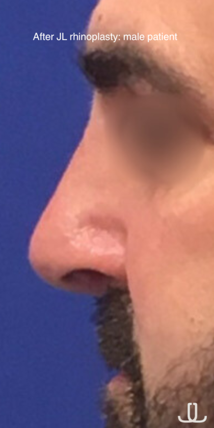 Rhinoplasty Before & After Patient #13785