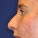 Rhinoplasty Before & After Patient #13760