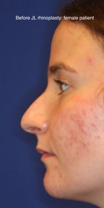 Rhinoplasty Before & After Patient #13760