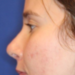 Rhinoplasty Before & After Patient #13760