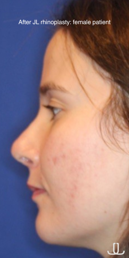 Rhinoplasty Before & After Patient #13760