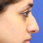 Rhinoplasty Before & After Patient #13751