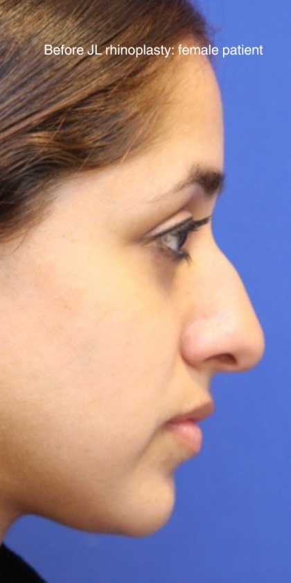 Patient #13751 Rhinoplasty Before and After Photos New York, NY ...