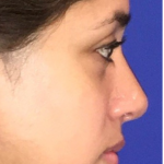 Rhinoplasty Before & After Patient #13751