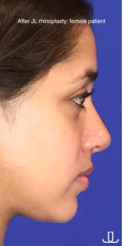 Rhinoplasty Before & After Patient #13751