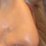 Rhinoplasty Before & After Patient #15860