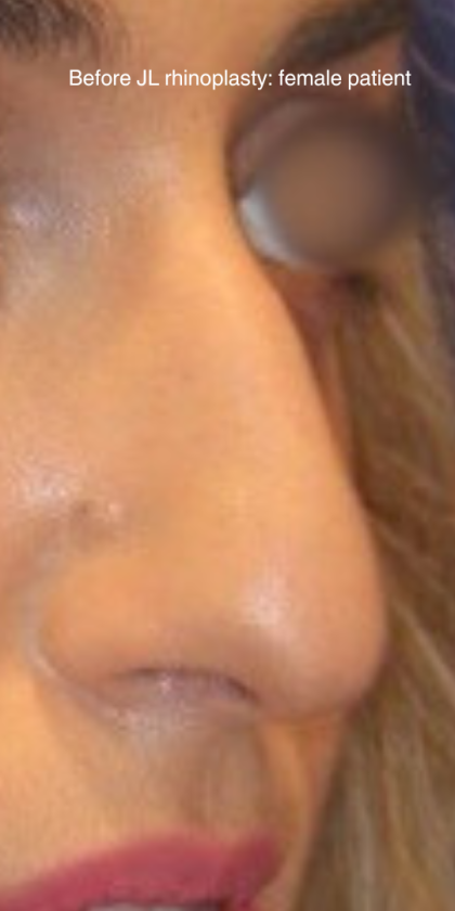 Rhinoplasty Before & After Patient #15860