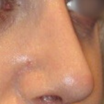 Rhinoplasty Before & After Patient #15860